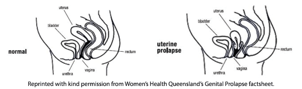 Prolapse Diagram